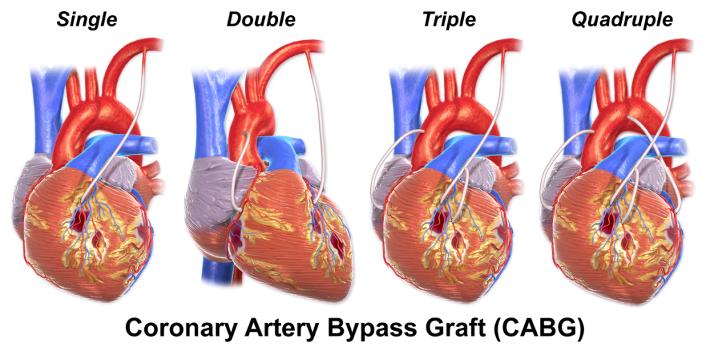 Heart Bypass Surgery Bypass Avenue
